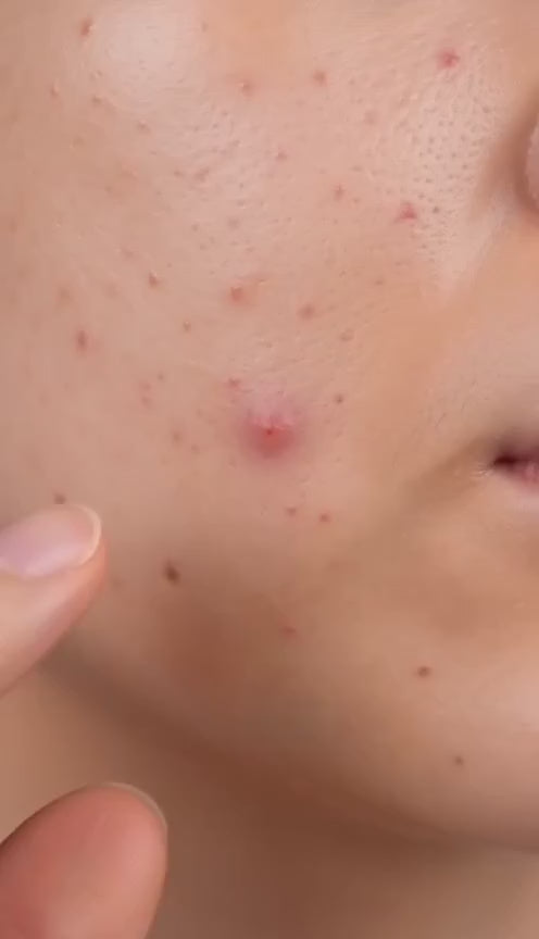 ClearSkin™ Star Pimple Patches